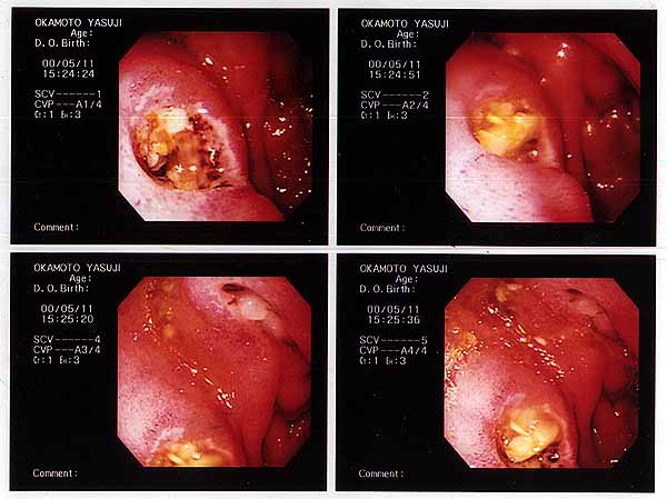 Duodenal Ulcer